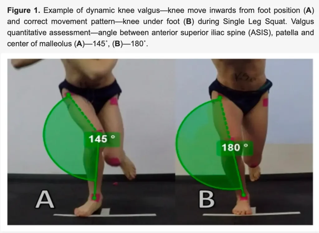 
무릎 부상 막는 5가지 핵심 요인 : 동적 무릎 외반증(Dynamic Knee Valgus, DKV) 완벽 가이드
