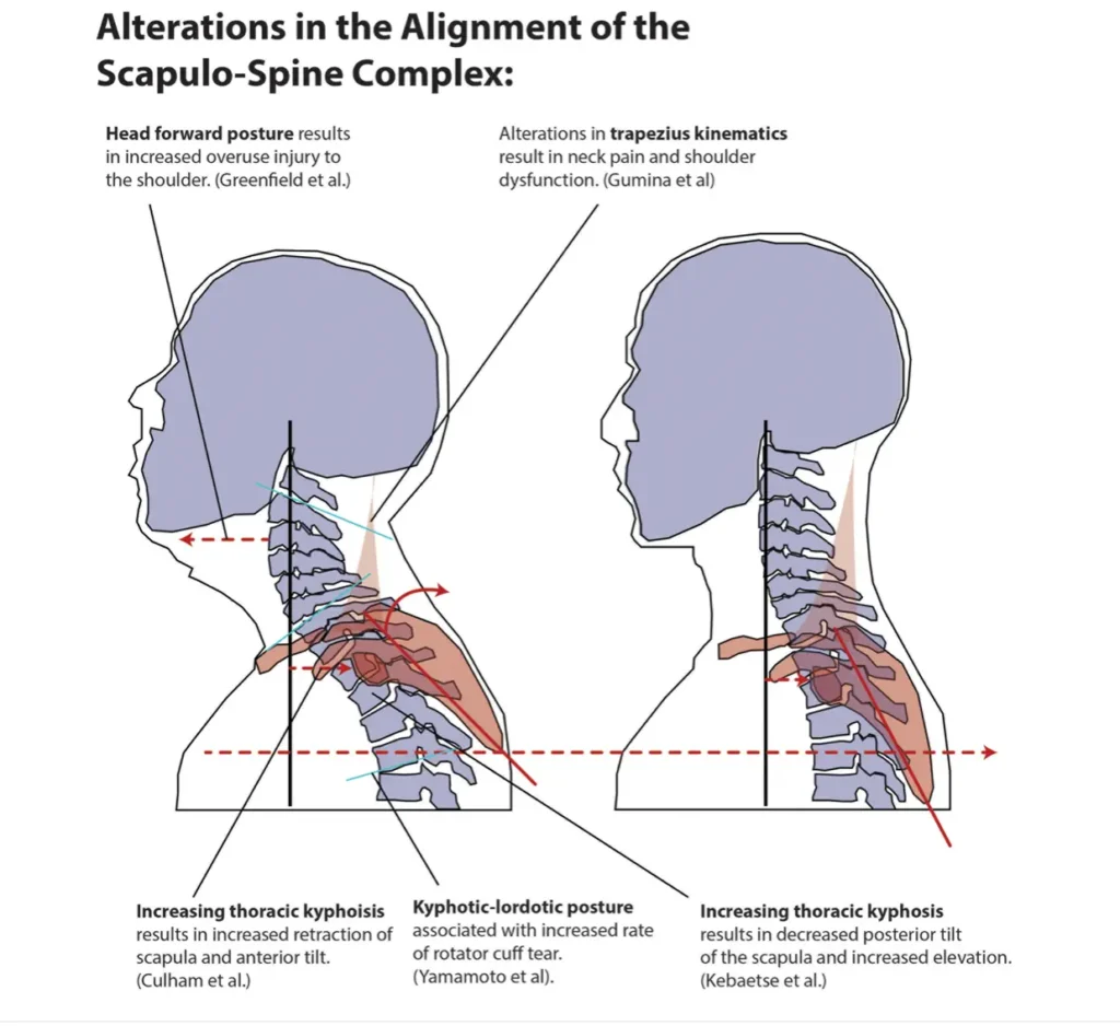 
어깨 손상이 목 정렬을 바꾼다! 어깨 통증 환자의 50%는 경추 병변이 동반 